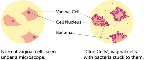 clue-cells_small What causes bacterial vaginosis News  